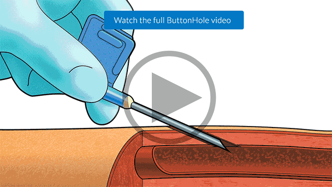 Watch the full ButtonHole video